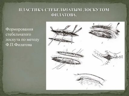 Стебель филатовой