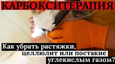 Подкожное введение углекислого газа