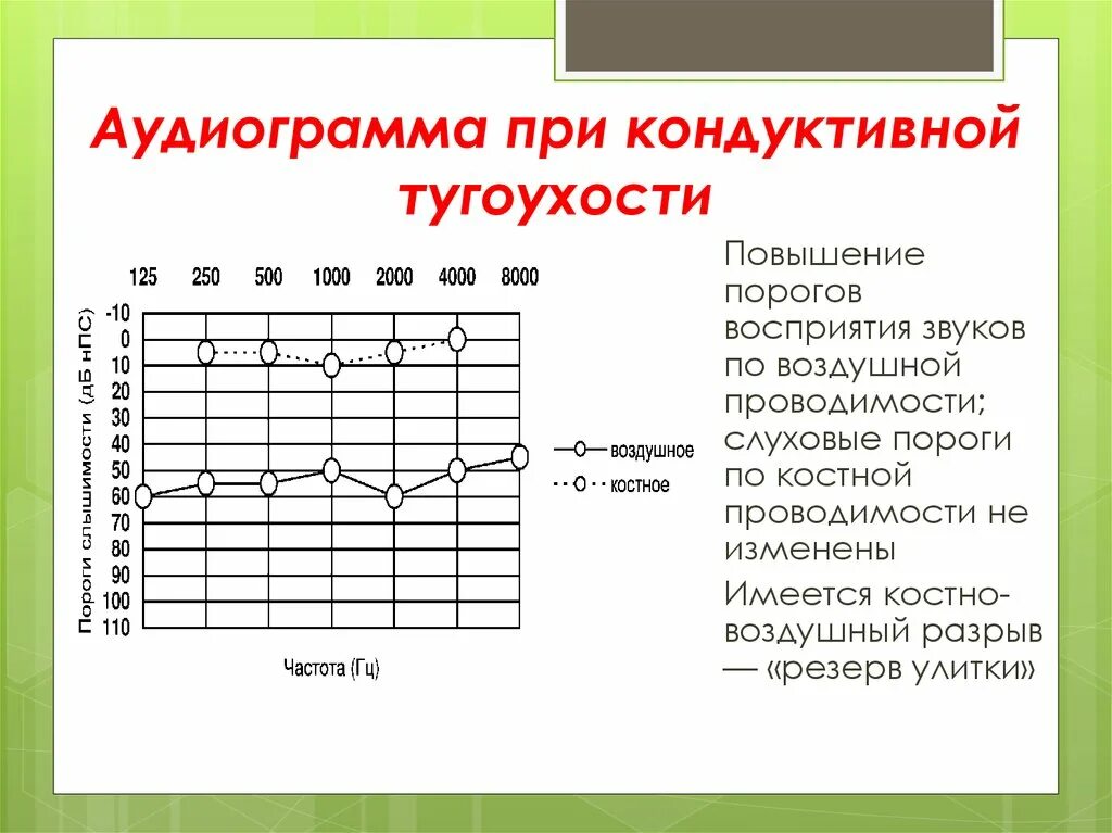 Аудиограмма степени. Тональная пороговая аудиограмма кондуктивная тугоухость. Кондуктивная тугоухость 2 степени аудиограмма. Аудиограмма 2 степени тугоухости. Тональная пороговая аудиометрия нейросенсорная тугоухость.