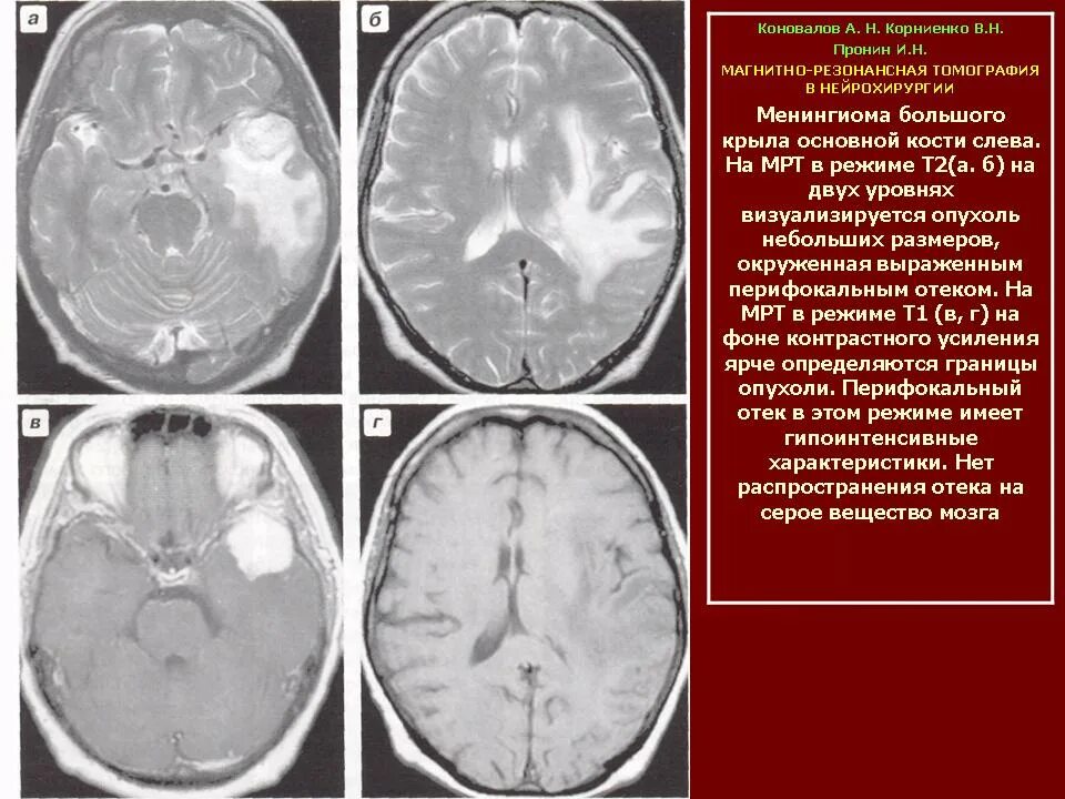 Перифокальный отек образования