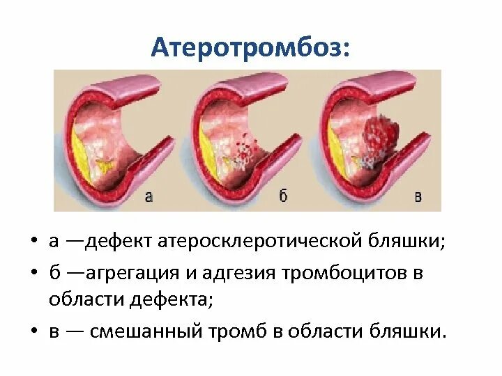 Разрыв атеросклеротической бляшки. Тромбоциты в атеросклеротической бляшке. Атеросклероз и Атеротромбоз.