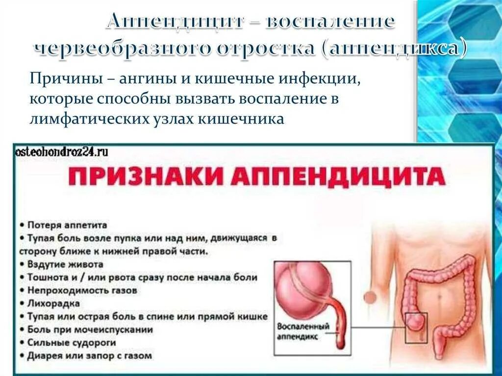 Как проверить аппендицит признаки аппендицита