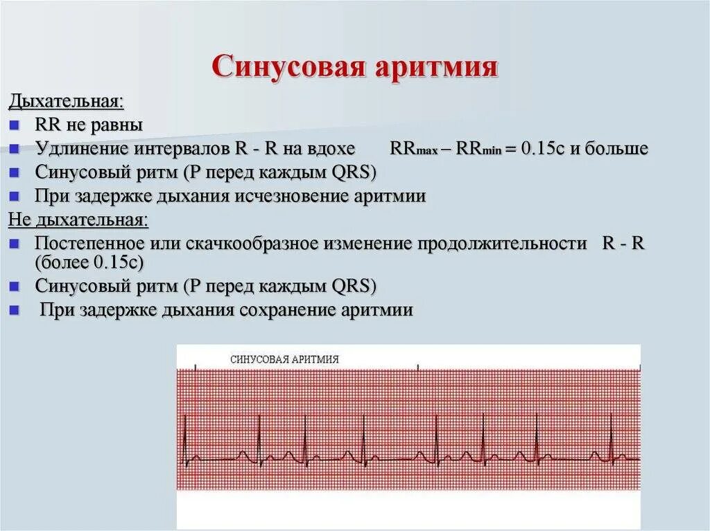 Сильное сердцебиение при нагрузках. ЭКГ критерии синусовой аритмии. 80-100 ЧСС синусовая аритмия. Синусовая тахикардия ЧСС 100 ЭКГ. Синусовая аритмия на ЭКГ У ребенка 11 лет.