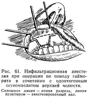 Анестезия верхней челюсти