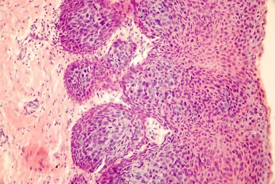 Плоскоклеточная карцинома шейки матки гистология. Гистология внутрипротоковой карциномы in situ. Аденокарцинома шейки матки микропрепарат. Инвазивный рак шейки