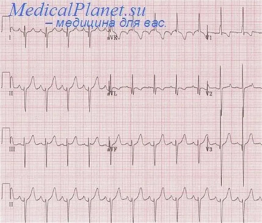 Гипертрофия обоих желудочков. Гипертрофия обоих предсердий. Гипертрофия правого желудочка на экг. Гипертрофия левого желудочка на экг. Гипертрофия обоих желудочков на экг.