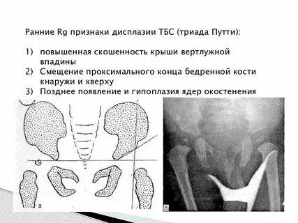 Окостенение тазобедренного сустава у детей