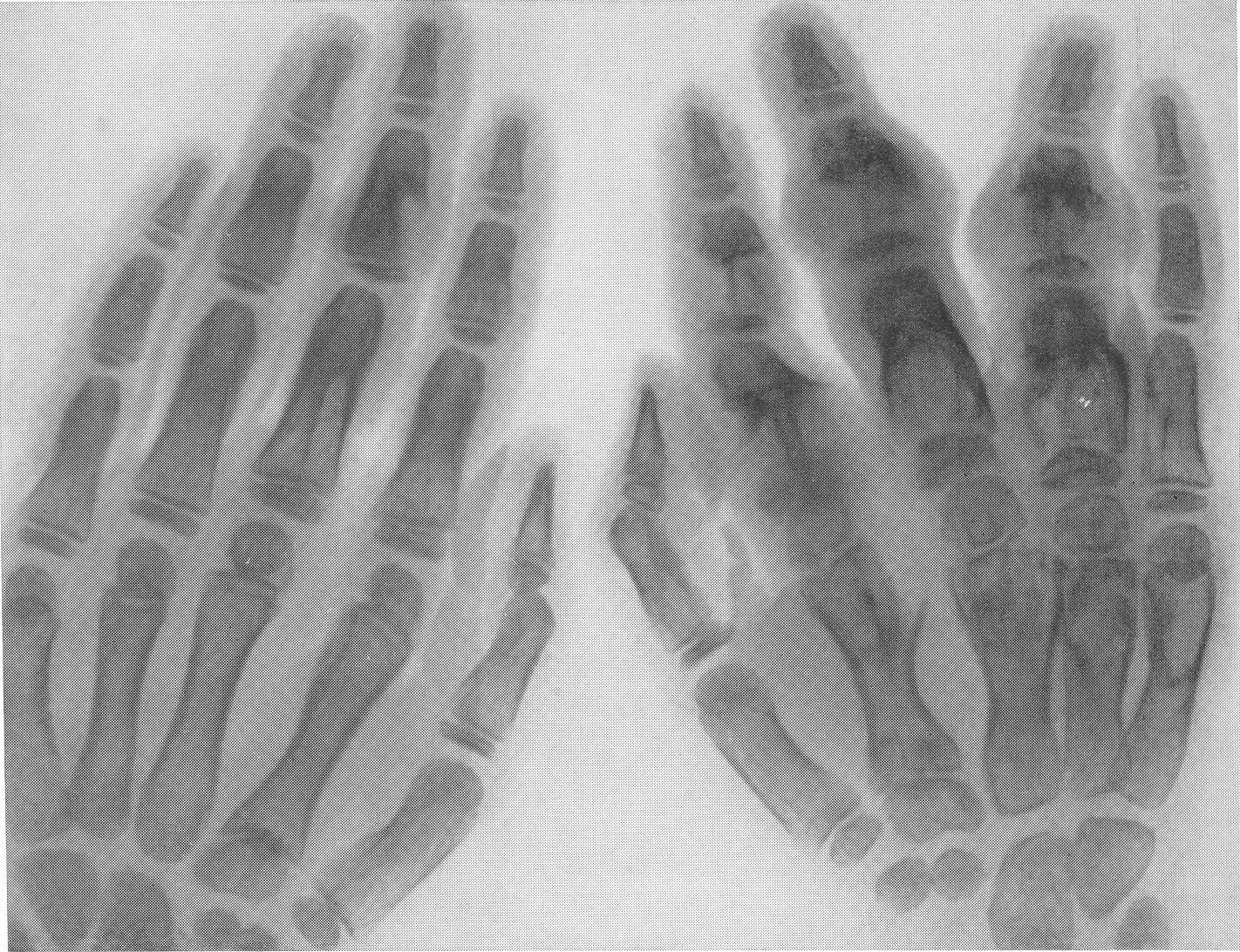 Дисхондроплазия болезнь олье. Болезнь олье рентген описание. Хондрома кости на рентгене. Болезнь олье. Хондрома пальца кисти рентген.