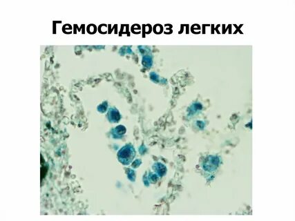 Гемосидероз это