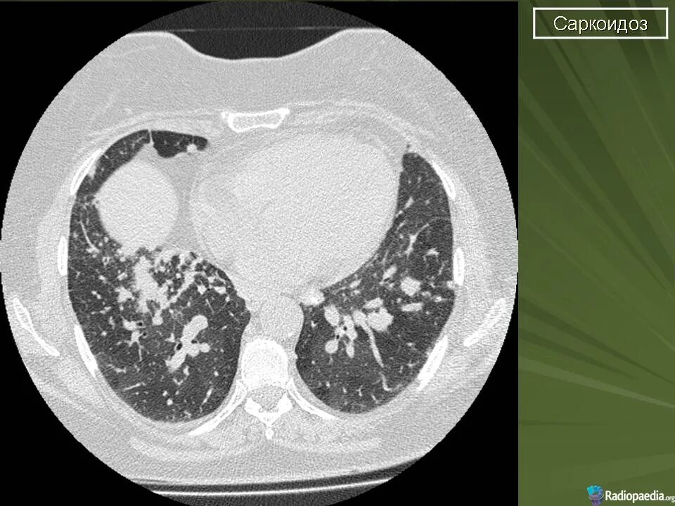 Саркоидоз 3. Саркоидоз Бека легких кт. Альвеолярная форма саркоидоза.