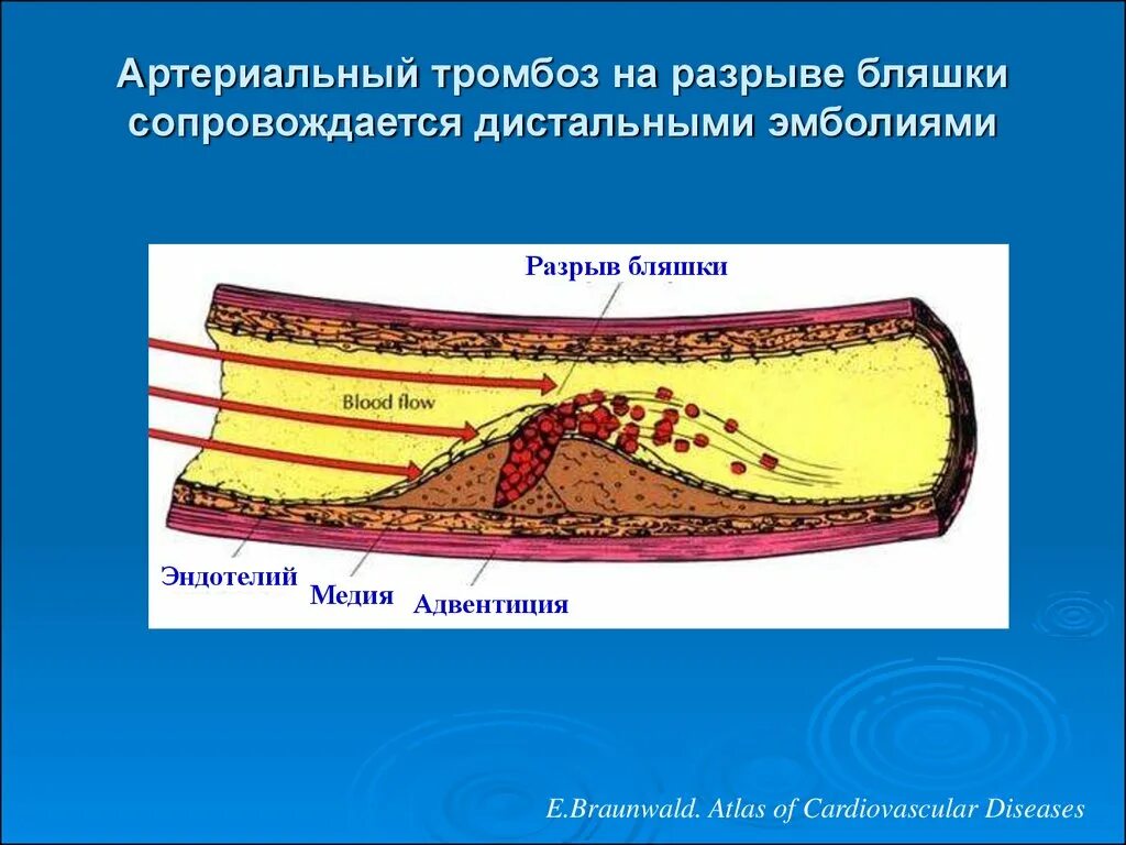 Повреждение атеросклеротической бляшки. Атеросклероз разрыв бляшки.