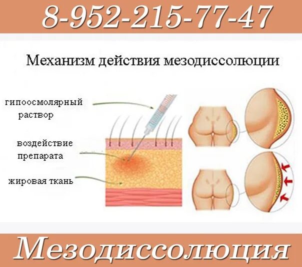 Мезодиссолюция