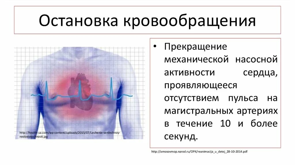 Причины внезапной остановки кровообращения. Клинические симптомы острой остановки кровообращения. Признаки прекращения кровообращения. Механизмы остановки кровообращения.