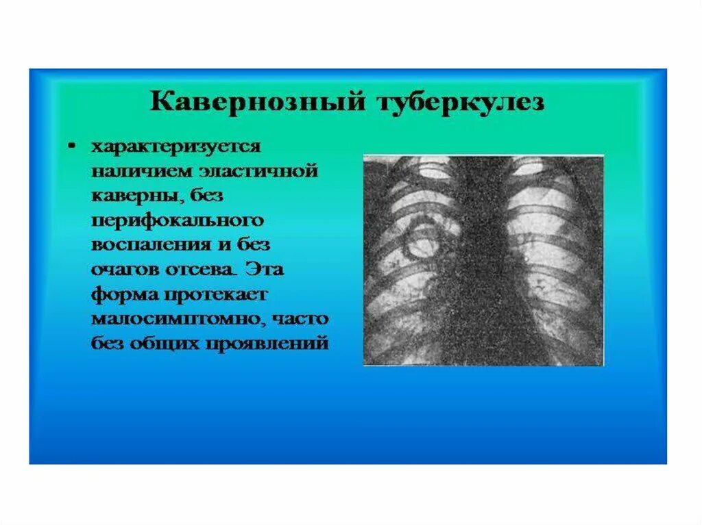 Кавернозная форма туберкулеза легких рентген. Каверна туберкулез рентген. Кавернозный туберкулез рентген. Фиброзно-кавернозный туберкулез рентген.