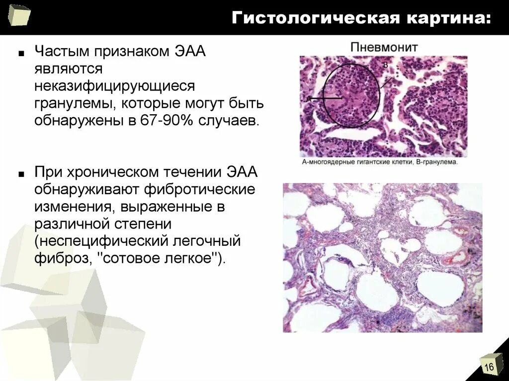 Альвеолиты рекомендации. Аллергический альвеолит патанатомия. Фиброзирующий альвеолит гистология. Экзогенный аллергический альвеолит. Экзогенный аллергический альвеолит гистология.