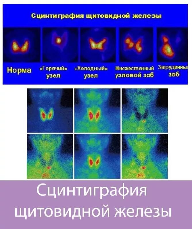 Радиоизотопный метод исследования щитовидной железы. Диффузный токсический зоб сцинтиграфия. Сцинтиграфия контрастное вещество. Гипотиреоз сцинтиграфия. Исследование зоба