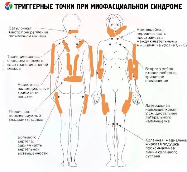 Миофасциальный синдром триггерные точки спины. Миофасциальные болевые триггерные точки тела человека. Болезненные точки при фибромиалгии. Болевые триггерные точки схема.