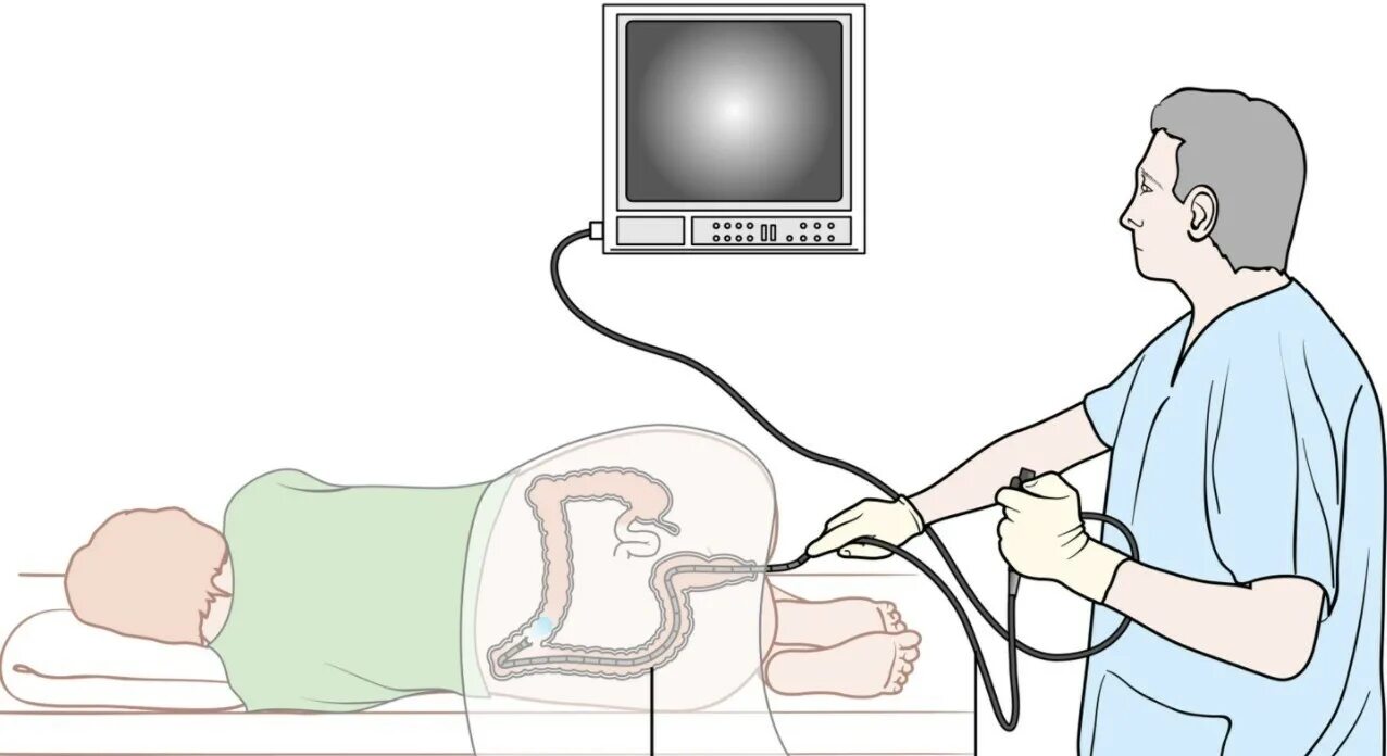 Подготовка пациента к ректороманоскопии колоноскопии. Колоноскопия алгоритм проведения процедуры. Колоноскопия схема проведения. Колоноскопия Толстого кишечника. Путь продвижения эндоскопа при колоноскопии.