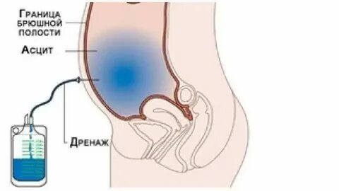Дренаж при асците