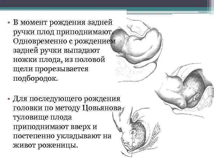 Пособие по Цовьянову при тазовом предлежании плода. Методика по Цовьянову при тазовом предлежании. Роды при тазовом предлежании плода презентация. Заднее предлежание плода