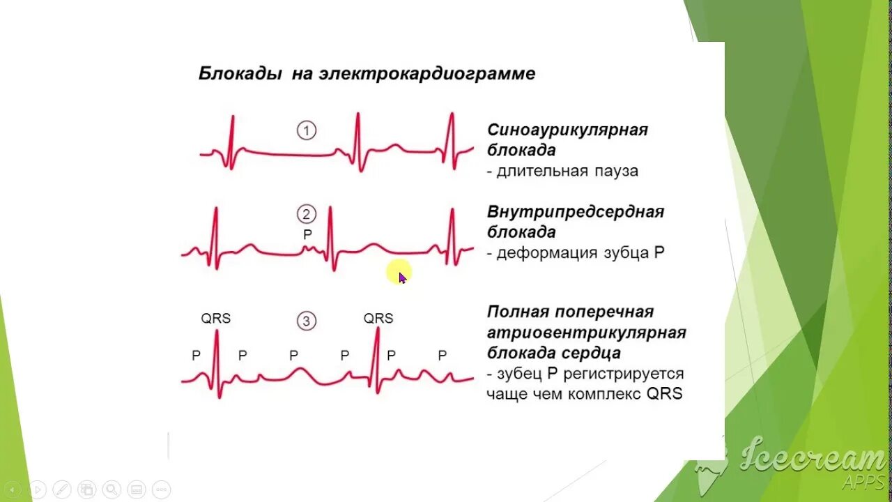 Блокада сердца опасно для жизни. Поперечная блокада сердца на ЭКГ. Полная поперечная блокада на ЭКГ. Полная поперечная блокада сердца. Блокада в сердце по ЭКГ У взрослого.