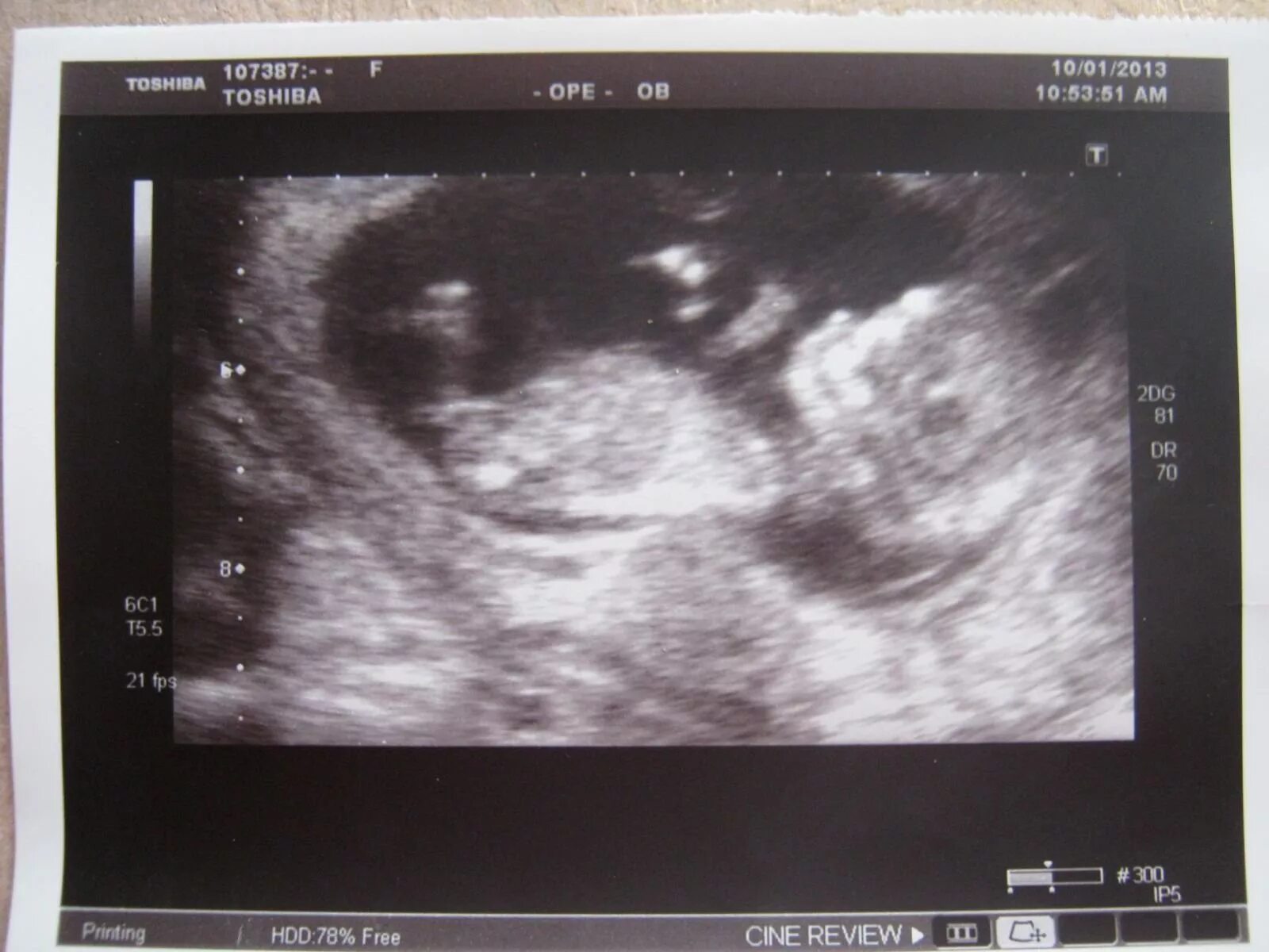11 неделя 6 день. Снимок УЗИ на 12 неделе. УЗИ на 11-12 неделе беременности скрининг. УЗИ 11-12 недель беременности.