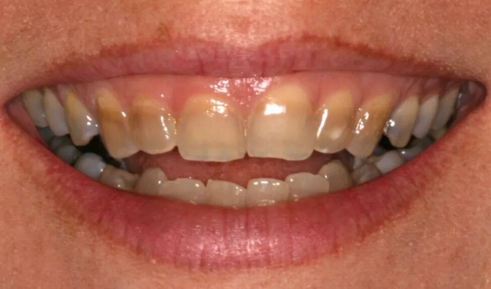 Деминерализация эмали зубов. Изменение цвета эмали. Изменение цвета эмали. Изменение цвета эмали. Гипоплазия эмали зубов.