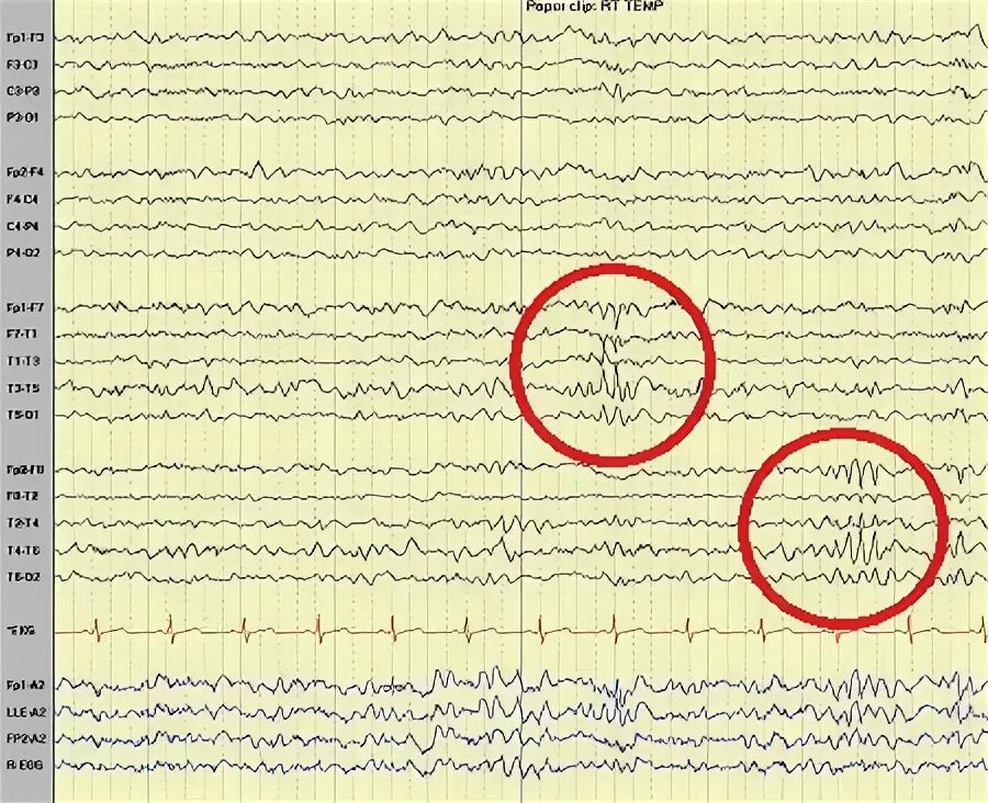 Эпи ээг. Wicket волны ЭЭГ. Бессудорожная эпилепсия на ЭЭГ. Спайк волновая активность на ЭЭГ. Эпи активность при ЭЭГ.