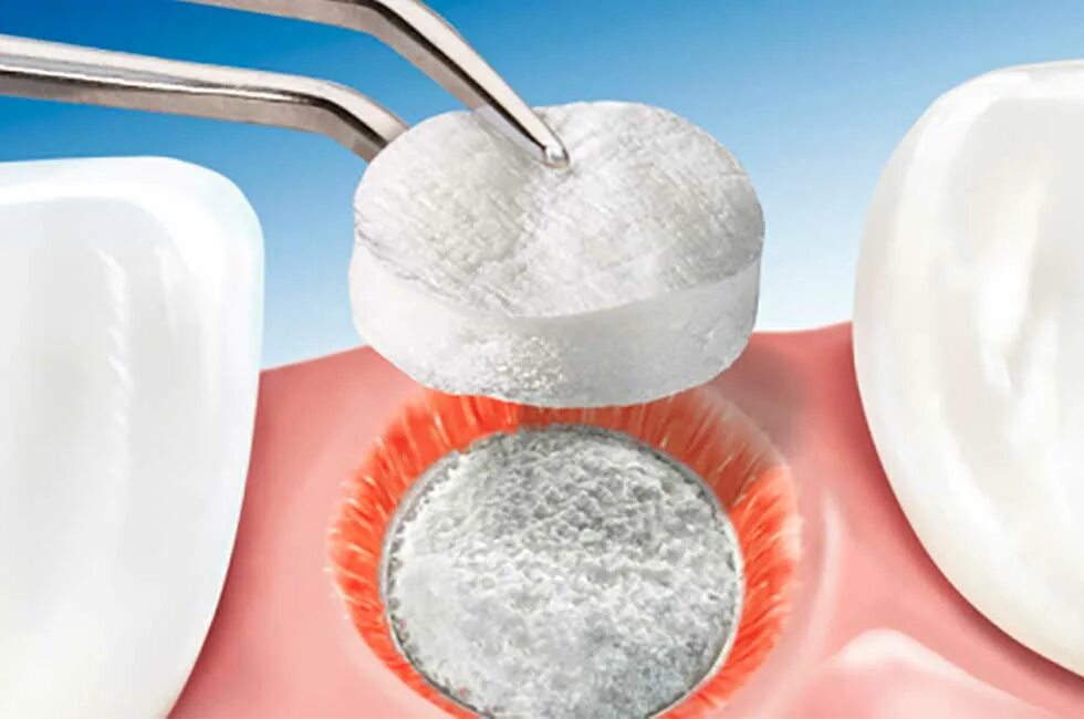 Костная пластика (остеопластика). Костный материал в стоматологии. Остеопластический материал в стоматологии. Гемостатическая губка в лунке зуба.