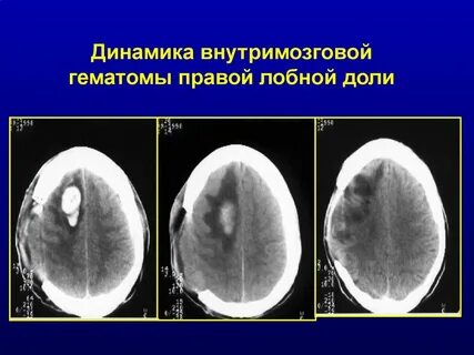 Инсульт лобной доли