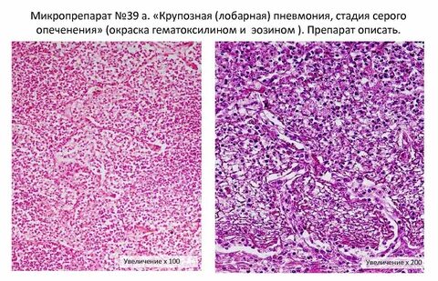 Клетки при гнойном воспалении