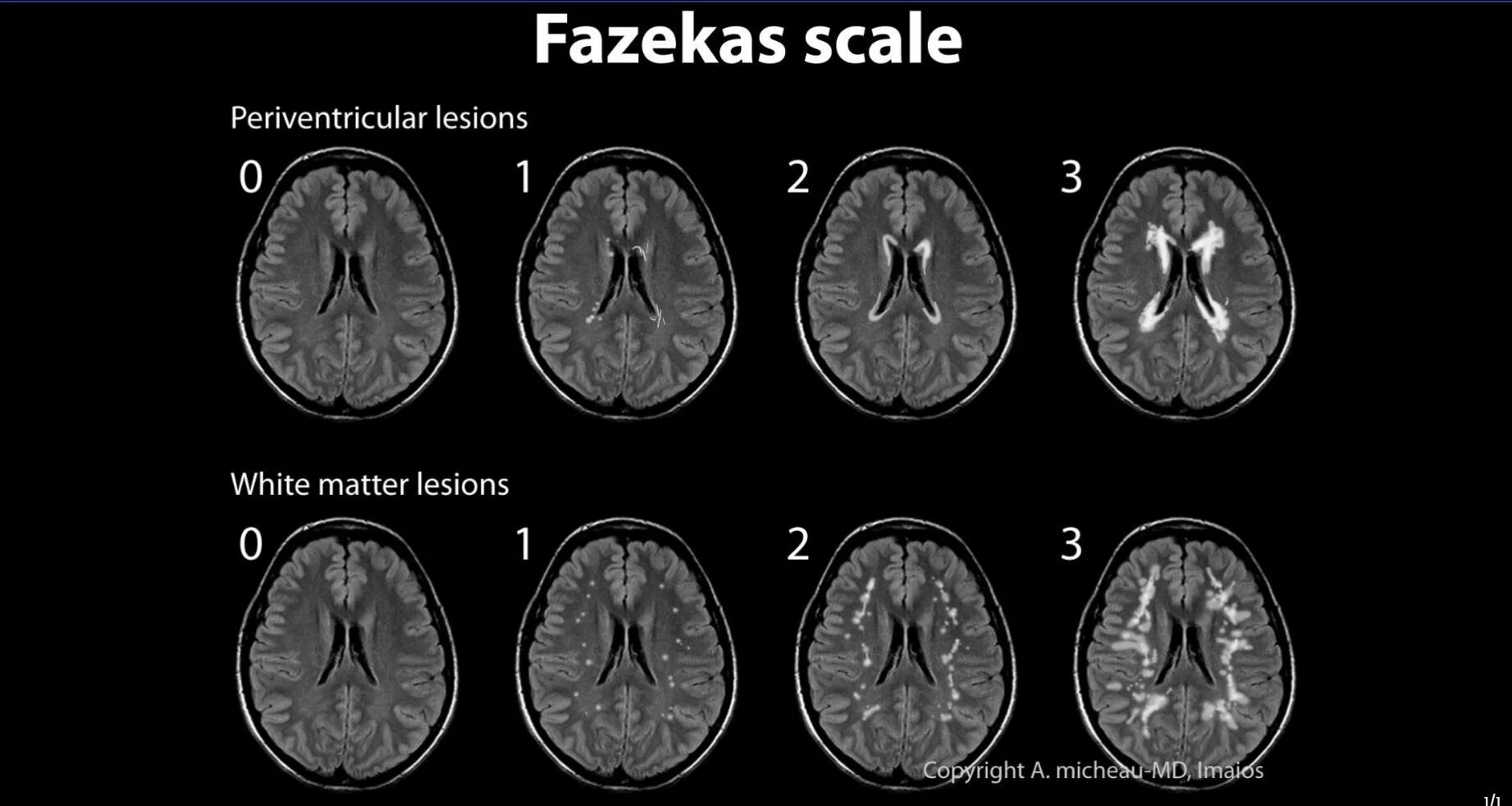 Микроангиопатия головного мозга fazekas