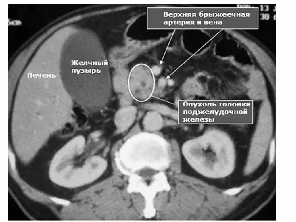 Контраст поджелудочной железы. Острый панкреатит кт отечная форма. Хронический панкреатит кт. Контраст поджелудочной железы. Кистозный фиброз поджелудочной железы кт.