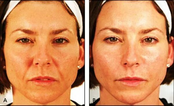 фейсбилдинг носогубные складки.