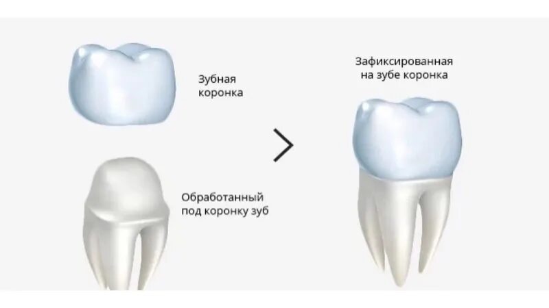 Виды коронок на зубы
