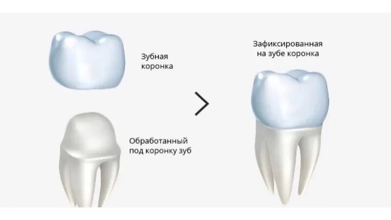 Схема установки коронки. Коронка на зуб схема. Восстановление зуба коронкой.