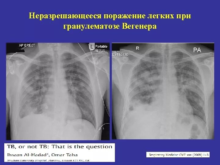 Поражение легкого 50. Процент поражения легких. Поражение легких при коронавирусе.