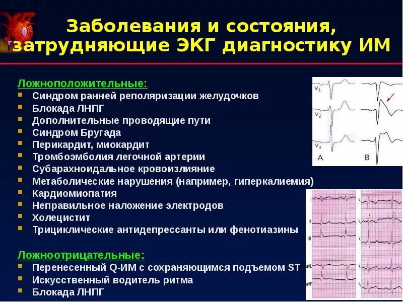 Снижение процессов реполяризации. Реполяризация миокарда желудочков экг. сррж на экг. синдром ранней реполяризации миокарда. реполяризация желудочков на экг.