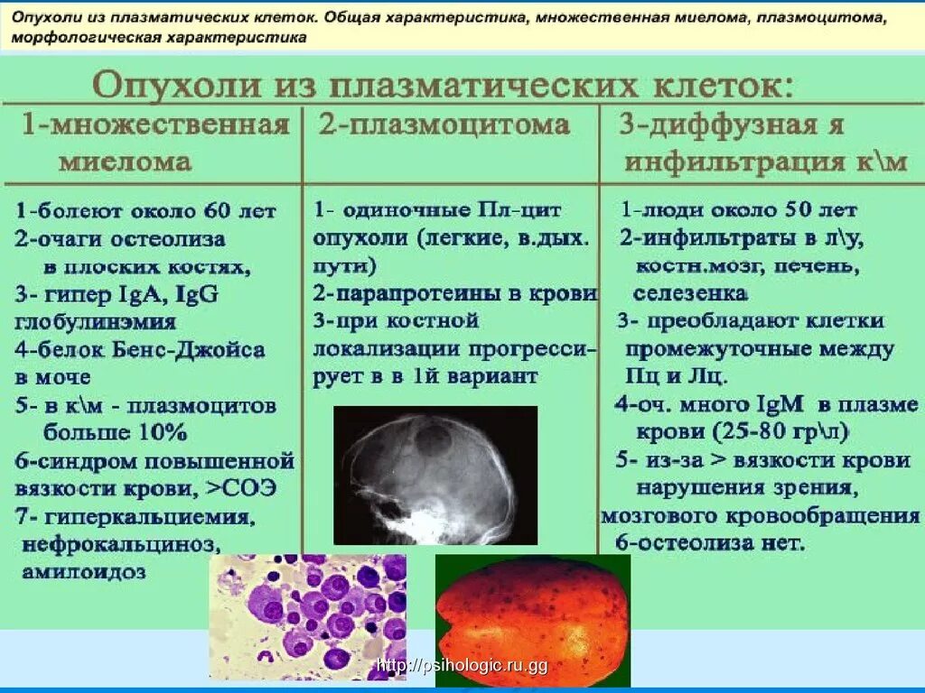 Основное свойство плазматической. Опухоли из плазматических клеток множественная миелома плазмоцитомы. Характеристика опухолей. Общая характеристика плазматических клеток. Синдром повышенной вязкости крови.