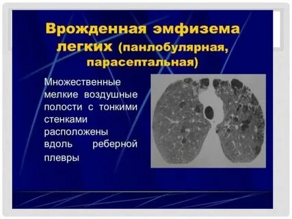 Парасептальная эмфизема на кт