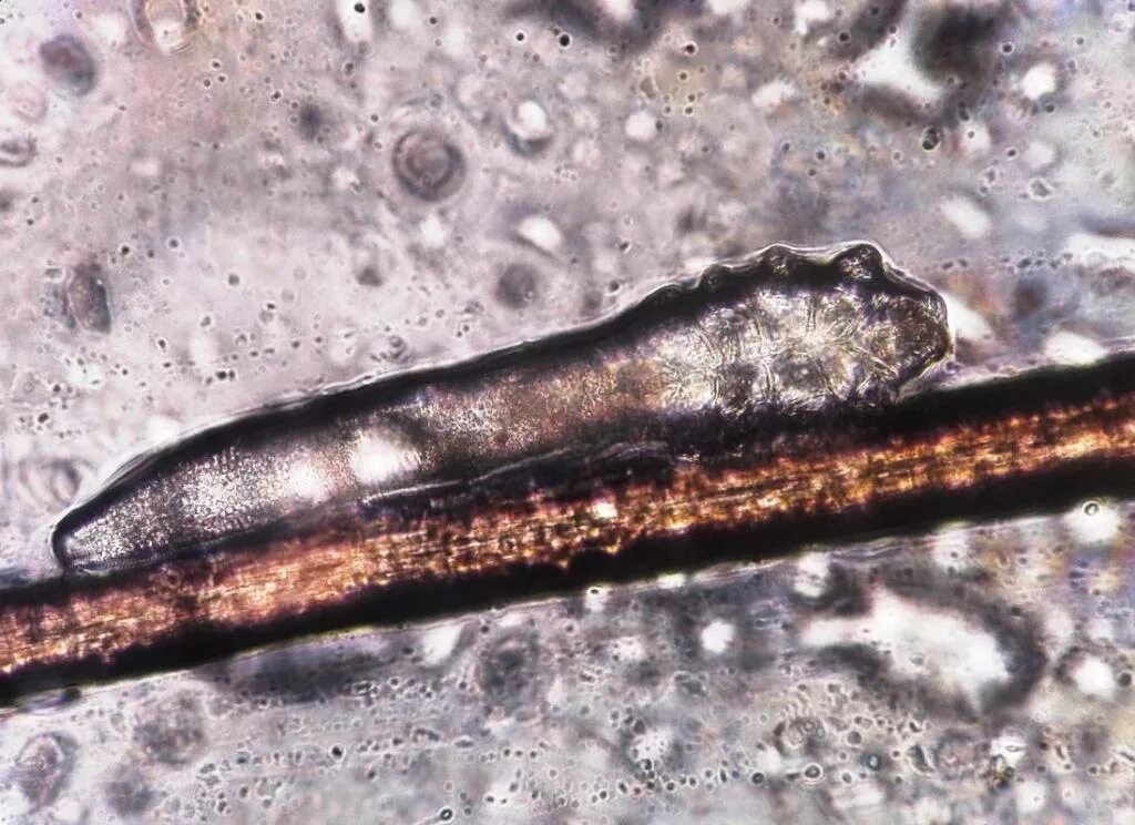 Железница угревая Demodex folliculorum