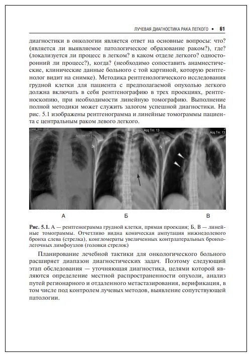 Рентгенограмма и рентгеноскопия органы грудной клетки патология. Сегменты правого легкого рентген. Долевое строение легких в прямой и боковой проекции. Ганцев ш.х. "рак легкого". Вопрос ответ онкологу