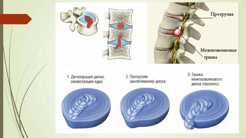 Дегенерация дисков. Фиброзное кольцо межпозвоночного диска. Строение позвонка и межпозвоночного диска. Пульпозное ядро межпозвоночного диска. Грыжи позвоночника в поясничном отделе схема.