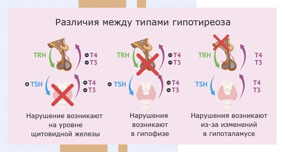 Типы гипотиреоза. Виды гипотиреоза. Субклинический гипотиреоз. Третичный гипотиреоз.