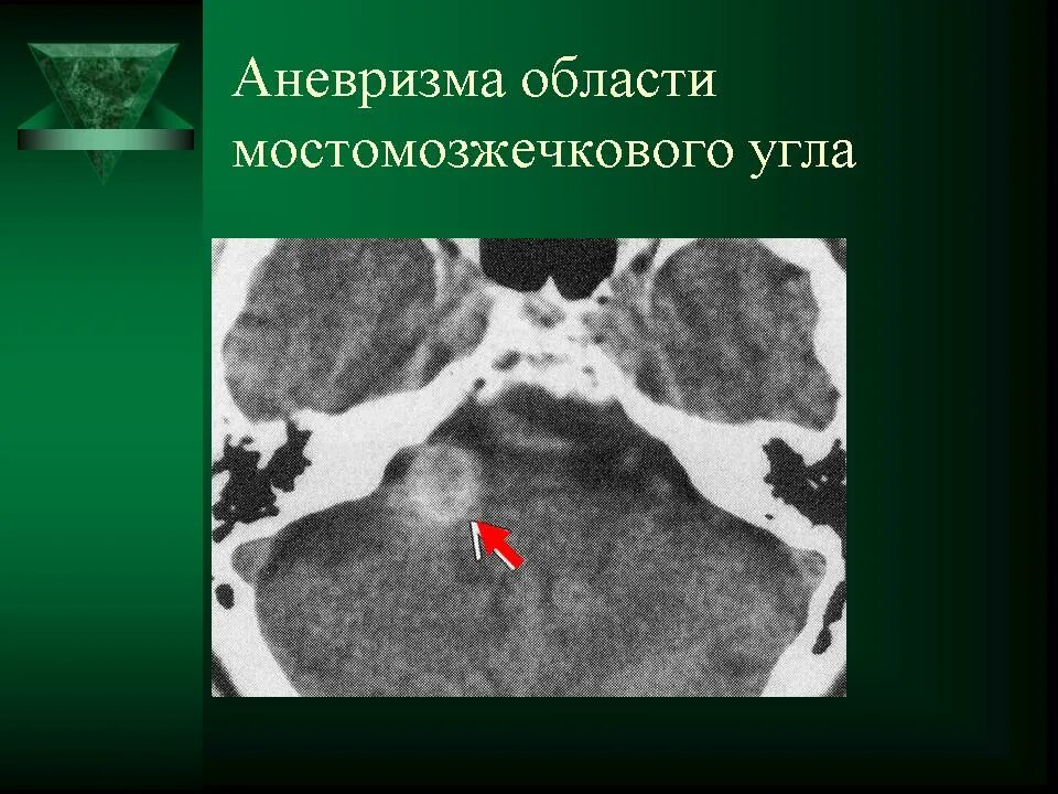 Опухоли мостомозжечкового угла мрт. Мосто-мозжечковый угол анатомия кт. Невринома мосто-мозжечкового угла кт. Мостомозжечковый угол на кт. Мозжечковая опухоль