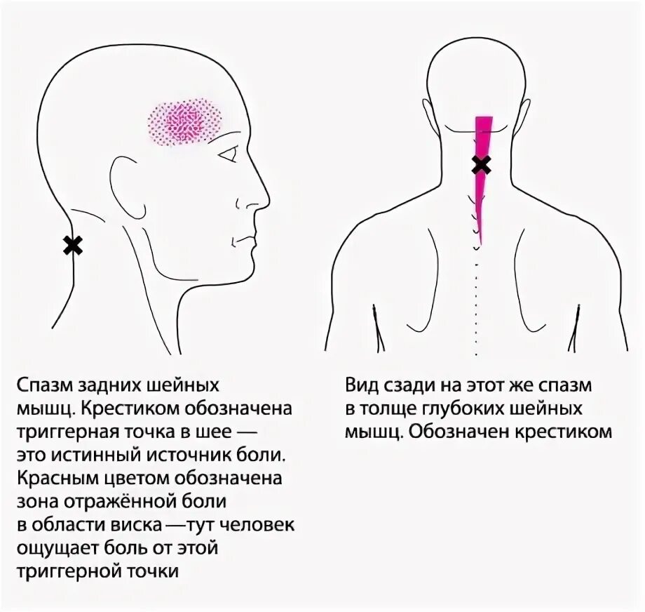 Немеет затылок причины. Головная боль локализация. Болит голова. Спазм мышц головы на затылке.