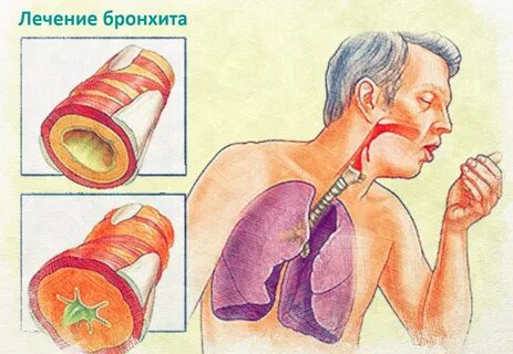 Что будет если не лечить бронхит