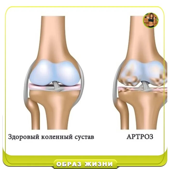 Деформирующий гонартроз коленного сустава. Деформирующий артроз 2 степени. Колено гонартроз 2 степени коленного сустава. Артроз коленного сустава название