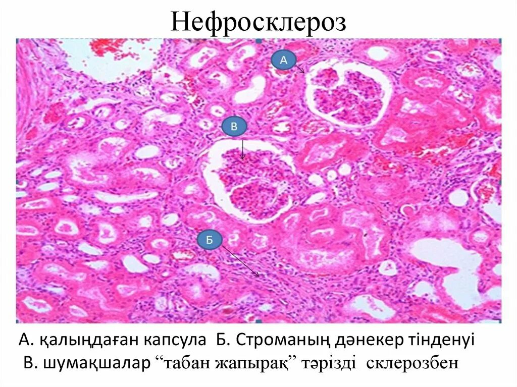Пиелонефрит микропрепарат. Артериолосклеротический нефросклероз (первично-сморщенная почка). Нефросклероз патанатомия. Некротический нефроз патологическая анатомия. Нефросклероз патологическая анатомия.