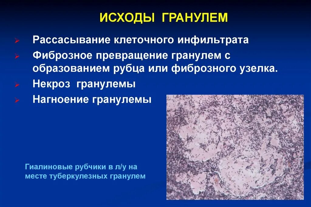 Риносклерома гранулема. Исходы гранулем. Исходы гранулем. Исходы продуктивного воспаления. Продуктивное гранулематозное воспаление.